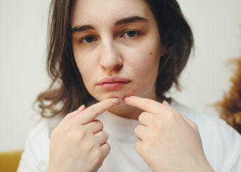 Descoperă cele mai eficiente tratamente pentru combaterea acneei