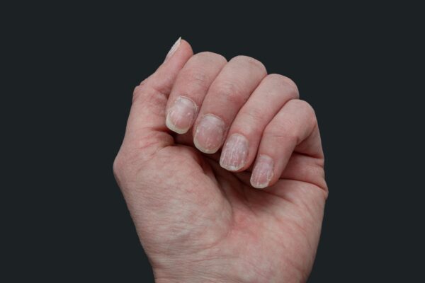 Unghii care se exfoliază: ce obiceiuri de îngrijire pot agrava problema